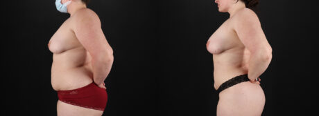 Liposuction case #6117