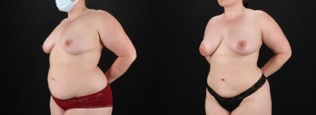 Liposuction case #6117