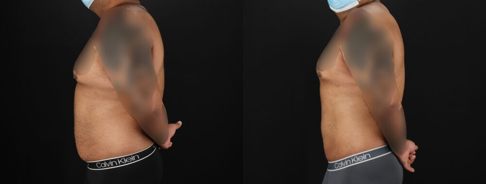 Liposuction case #6116