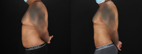 Liposuction case #6116