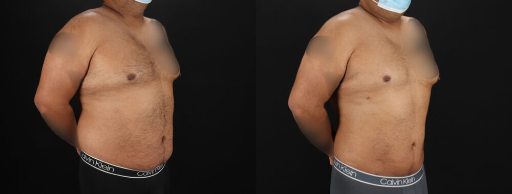 Liposuction case #6116