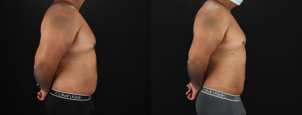 Liposuction case #6116