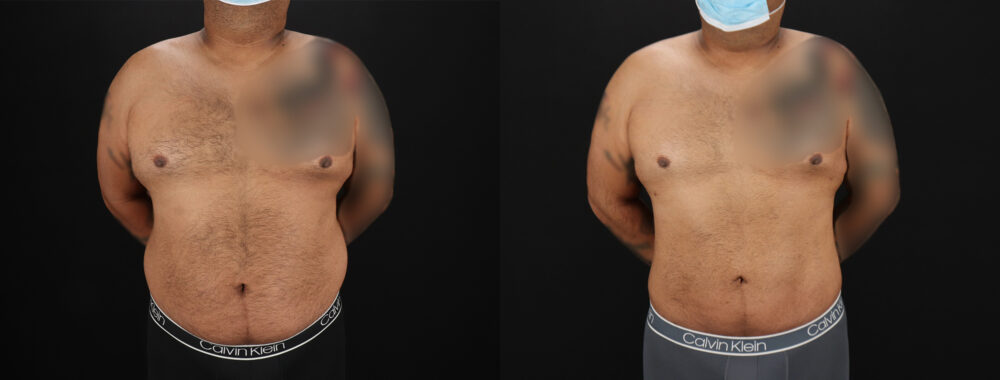 Liposuction case #6116