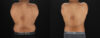 Liposuction case #6116 slider thumbnail