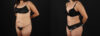 Tummy Tuck case #7461 slider thumbnail