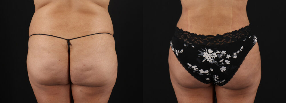 Tummy Tuck case #7461