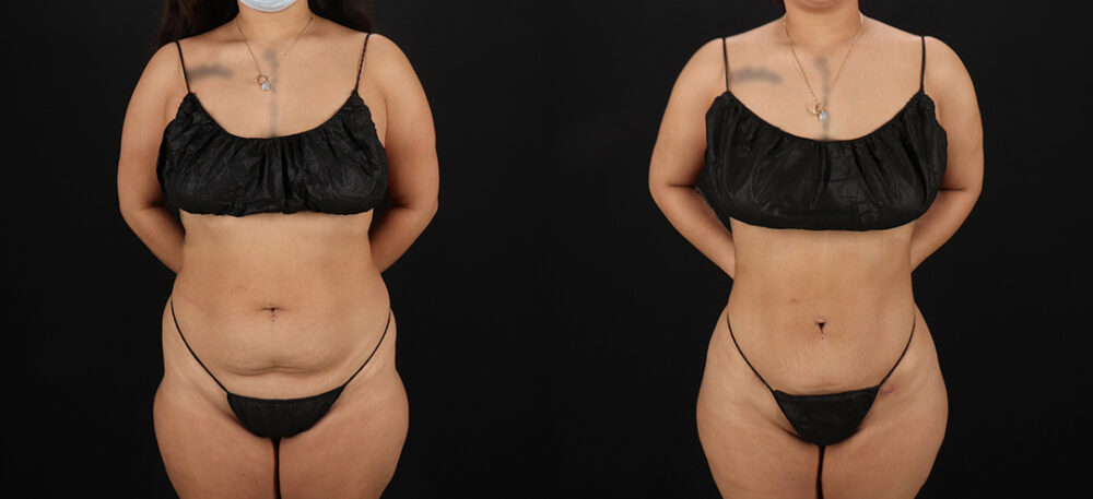 Brazilian Butt Lift case #5270