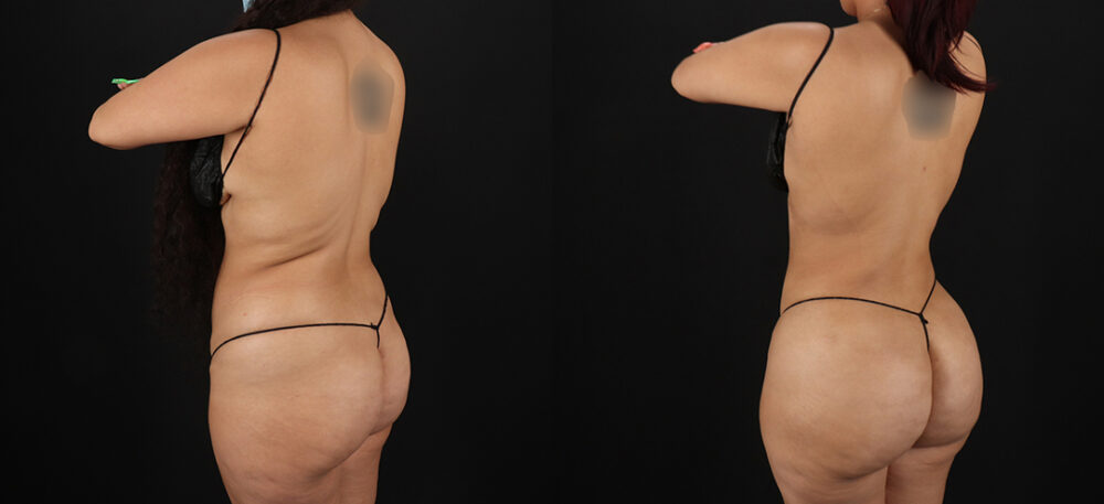 Brazilian Butt Lift case #5270