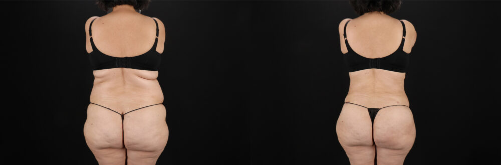 Liposuction case #6115