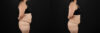 Liposuction case #6115 slider thumbnail