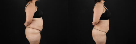 Liposuction case #6115