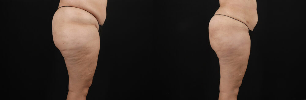 Liposuction case #6115