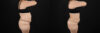 Liposuction case #6115 slider thumbnail