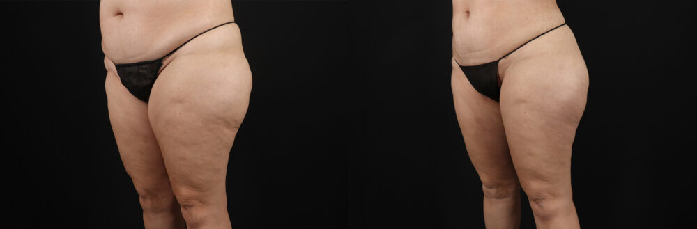 Liposuction case #6115