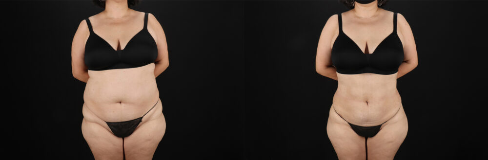 Liposuction case #6115