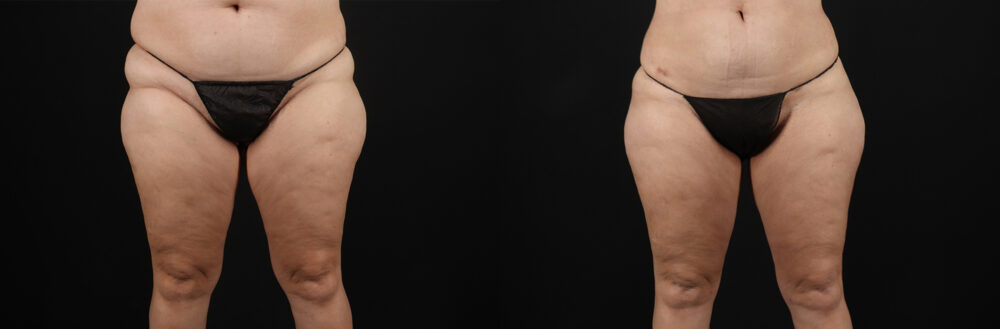 Liposuction case #6115