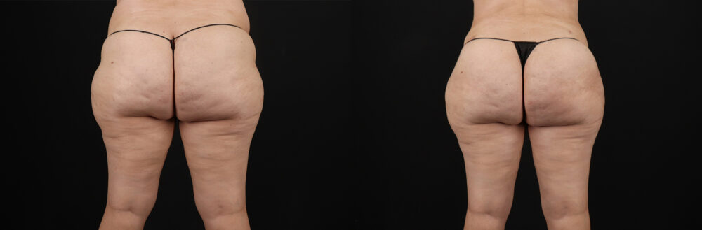 Liposuction case #6115