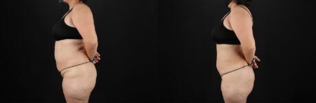 Liposuction case #6115