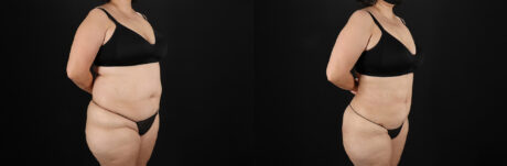 Liposuction case #6115