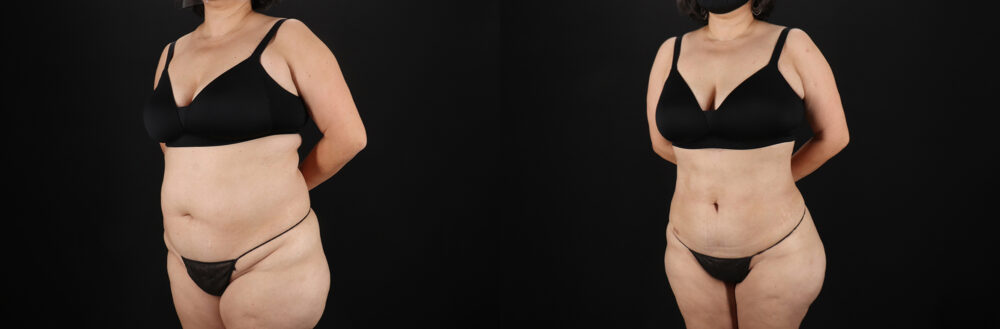 Liposuction case #6115