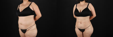 Liposuction case #6115