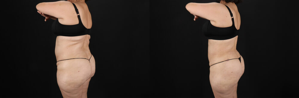 Liposuction case #6115