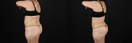 Liposuction case #6115