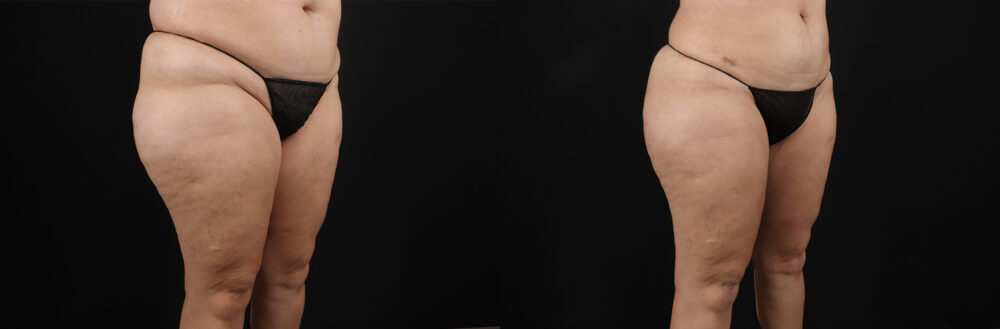 Liposuction case #6115