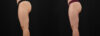 Liposuction case #6114 slider thumbnail