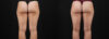 Liposuction case #6114 slider thumbnail