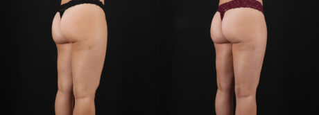 Liposuction case #6114