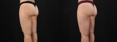 Liposuction case #6114