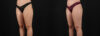 Liposuction case #6114 slider thumbnail