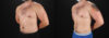 Liposuction case #6113 slider thumbnail