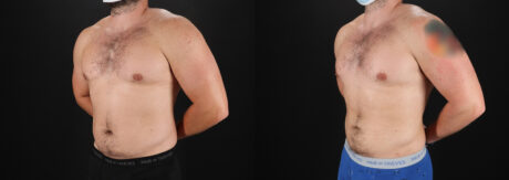 Liposuction case #6113