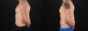 Liposuction case #6113 slider thumbnail