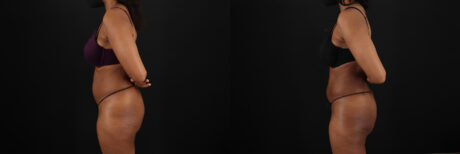 Liposuction case #6118