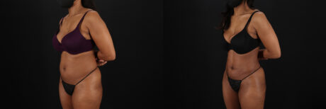 Liposuction case #6118