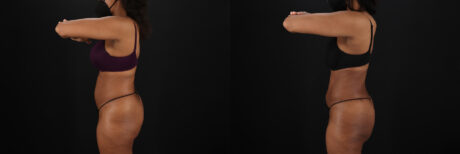 Liposuction case #6118