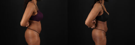 Liposuction case #6118