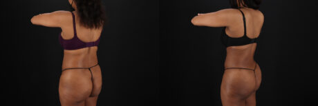 Liposuction case #6118