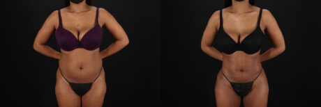 Liposuction case #6118