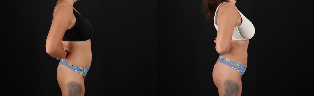 Brazilian Butt Lift case #5272