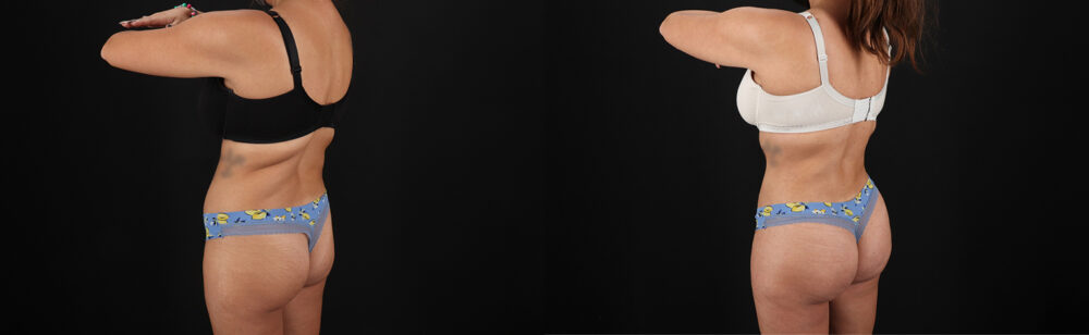 Brazilian Butt Lift case #5272