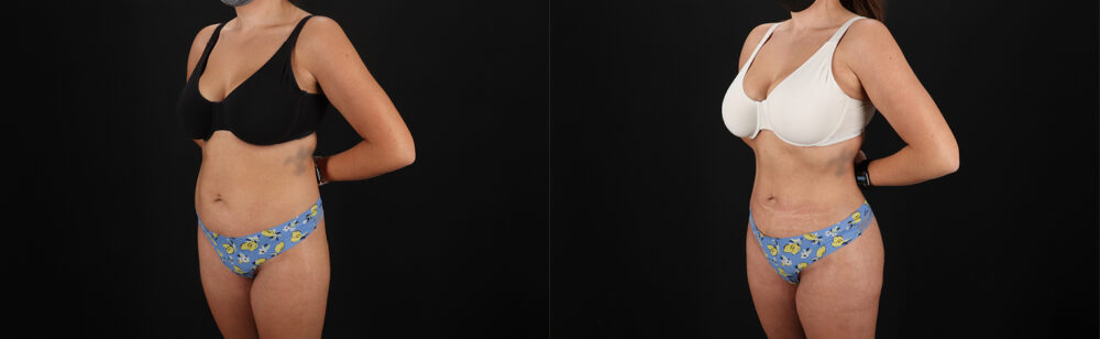 Brazilian Butt Lift case #5272