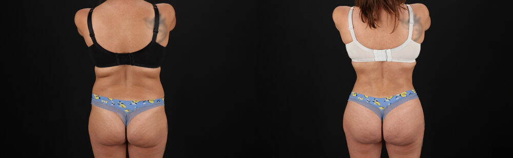 Brazilian Butt Lift case #5272