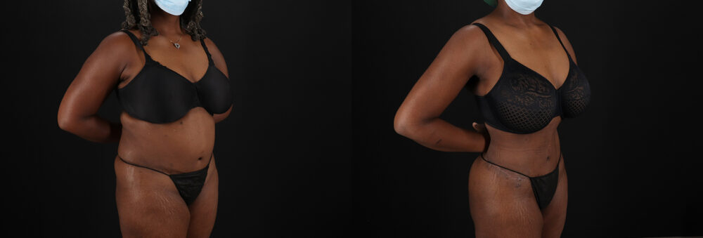 Brazilian Butt Lift case #5271