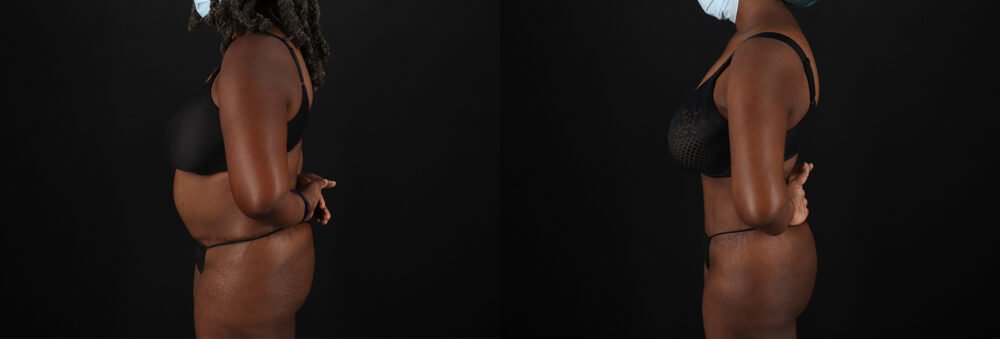 Brazilian Butt Lift case #5271