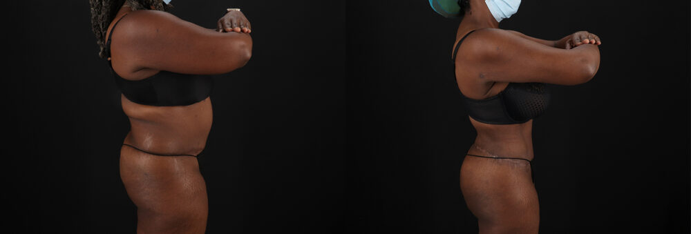 Brazilian Butt Lift case #5271