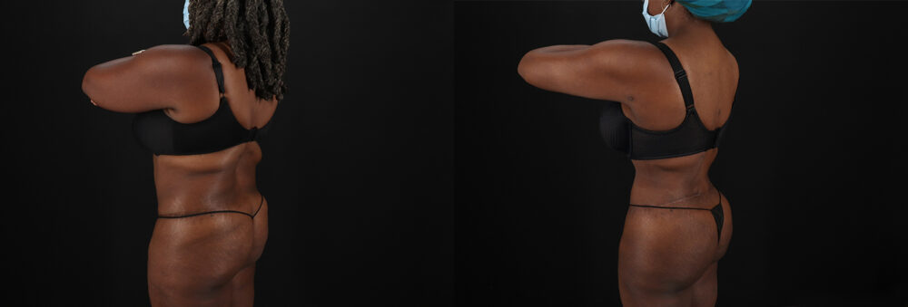 Brazilian Butt Lift case #5271